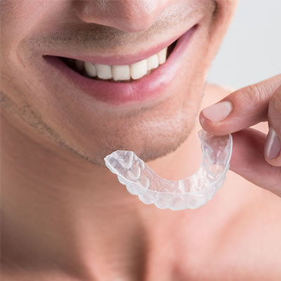 clear aligners